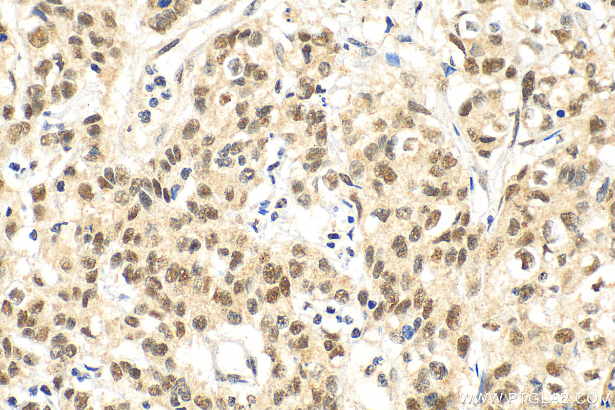 Immunohistochemistry (IHC) staining of human stomach cancer tissue using METTL3 Polyclonal antibody (29314-1-AP)