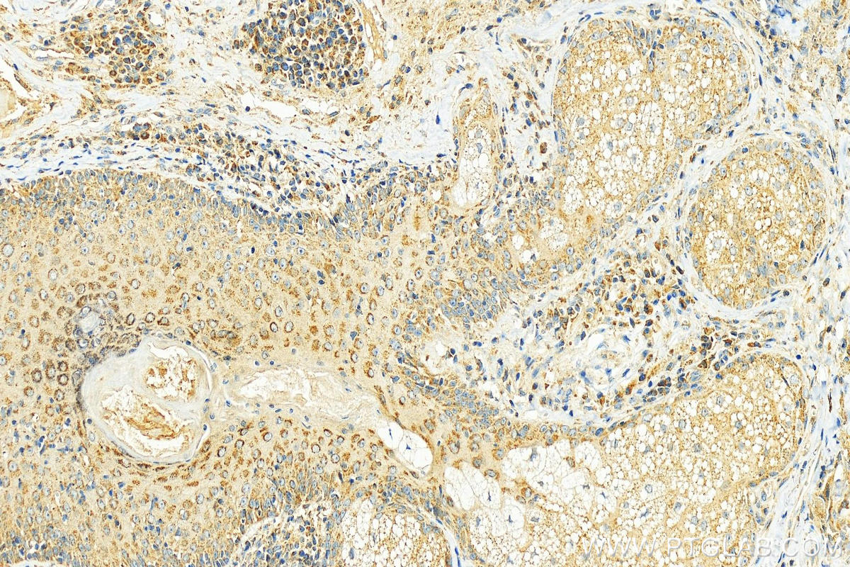 Immunohistochemistry (IHC) staining of human skin cancer tissue using MFG-E8 Polyclonal antibody (25951-1-AP)