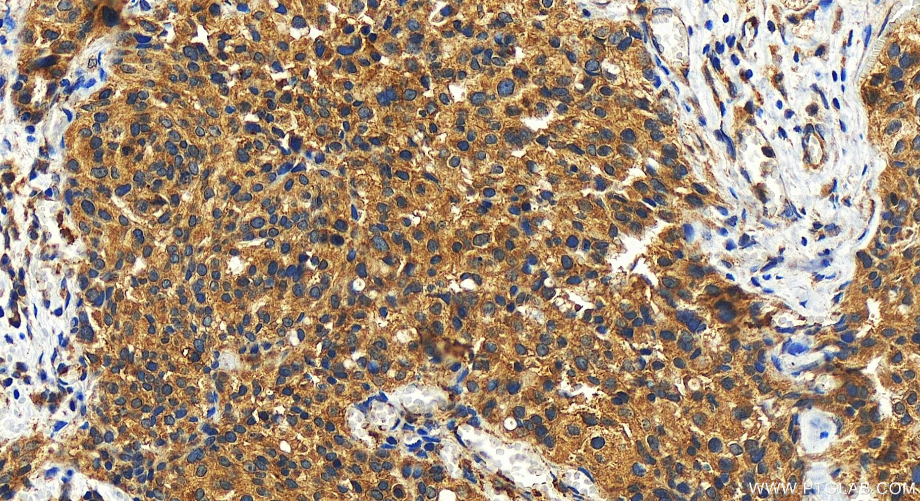 Immunohistochemistry (IHC) staining of human ovary cancer tissue using MFI2 Polyclonal antibody (10428-1-AP)