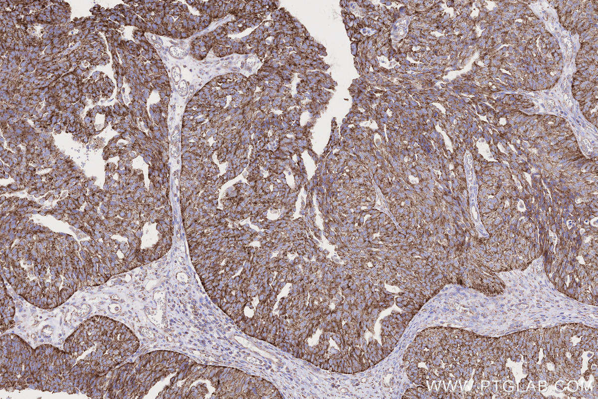 Immunohistochemistry (IHC) staining of human ovary cancer tissue using MFN1 Monoclonal antibody (66776-1-Ig)