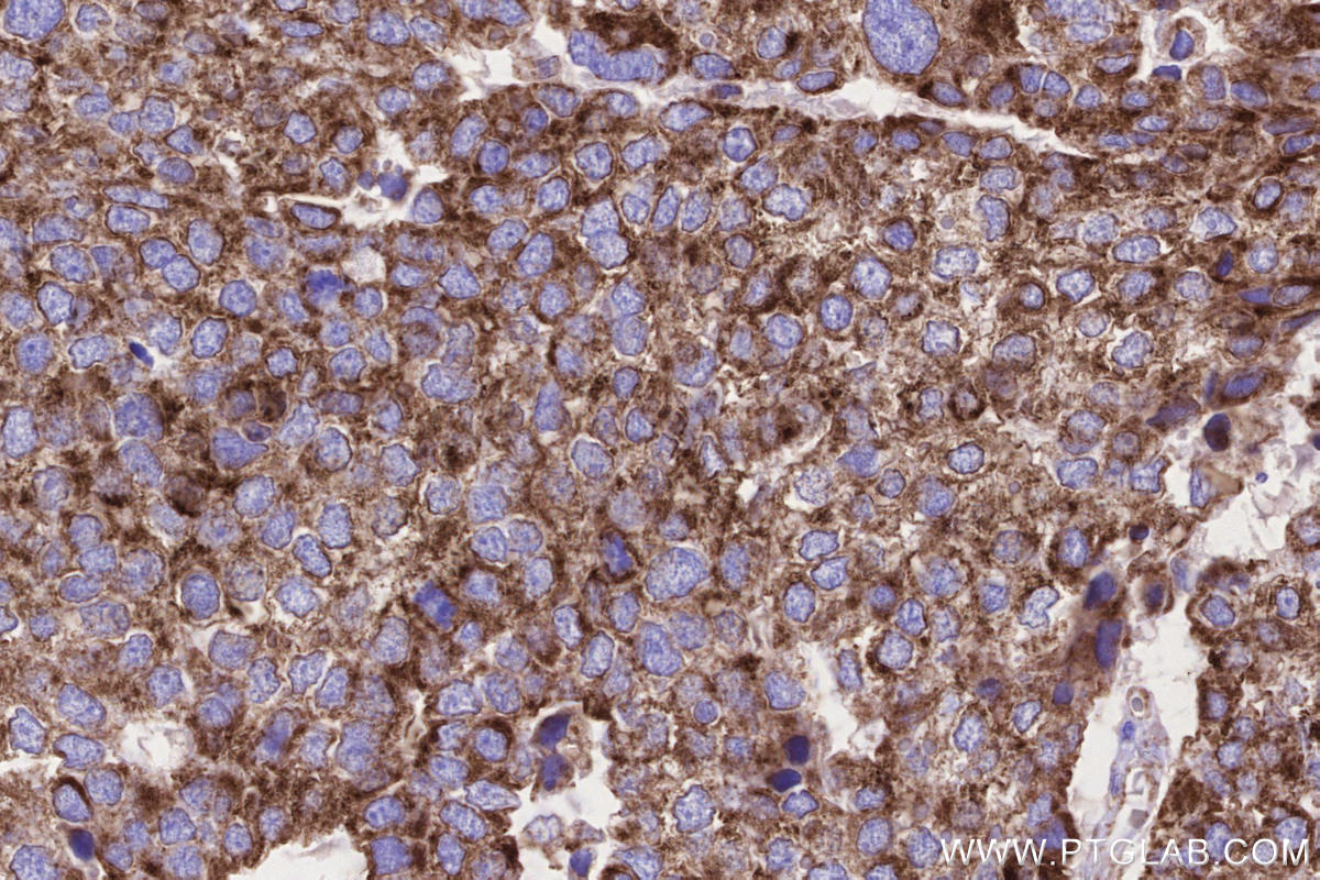 Immunohistochemistry (IHC) staining of human stomach cancer tissue using MFN1 Monoclonal antibody (66776-1-Ig)