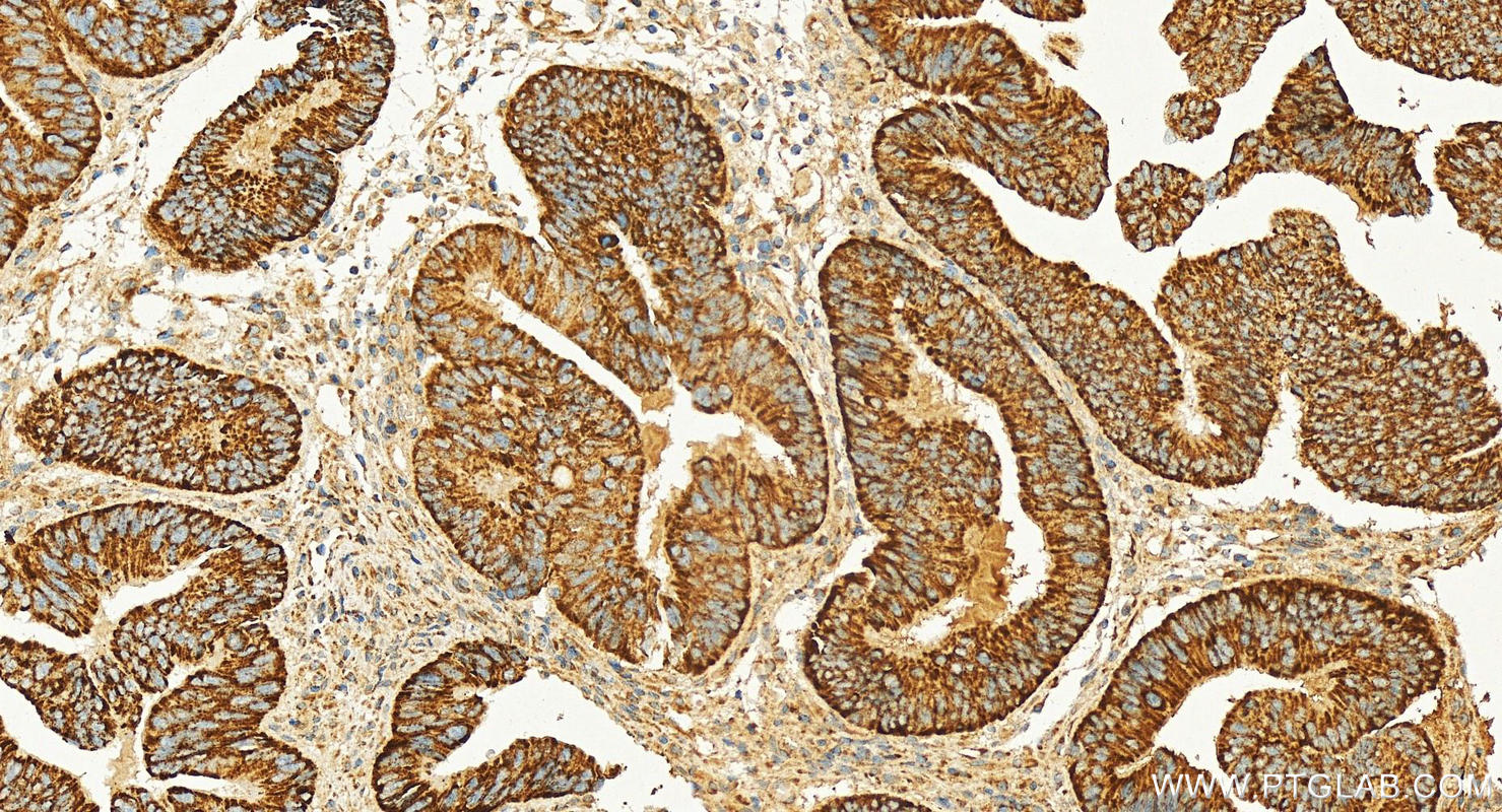 Immunohistochemistry (IHC) staining of human colon cancer tissue using MGP Monoclonal antibody (60055-1-Ig)