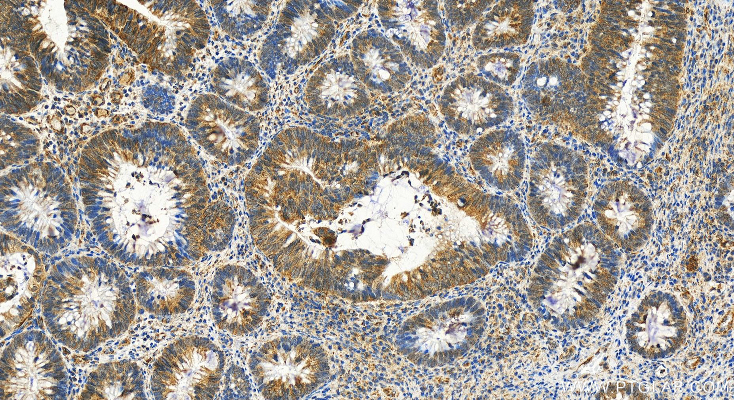 Immunohistochemistry (IHC) staining of human colon cancer tissue using MICB Polyclonal antibody (14325-1-AP)