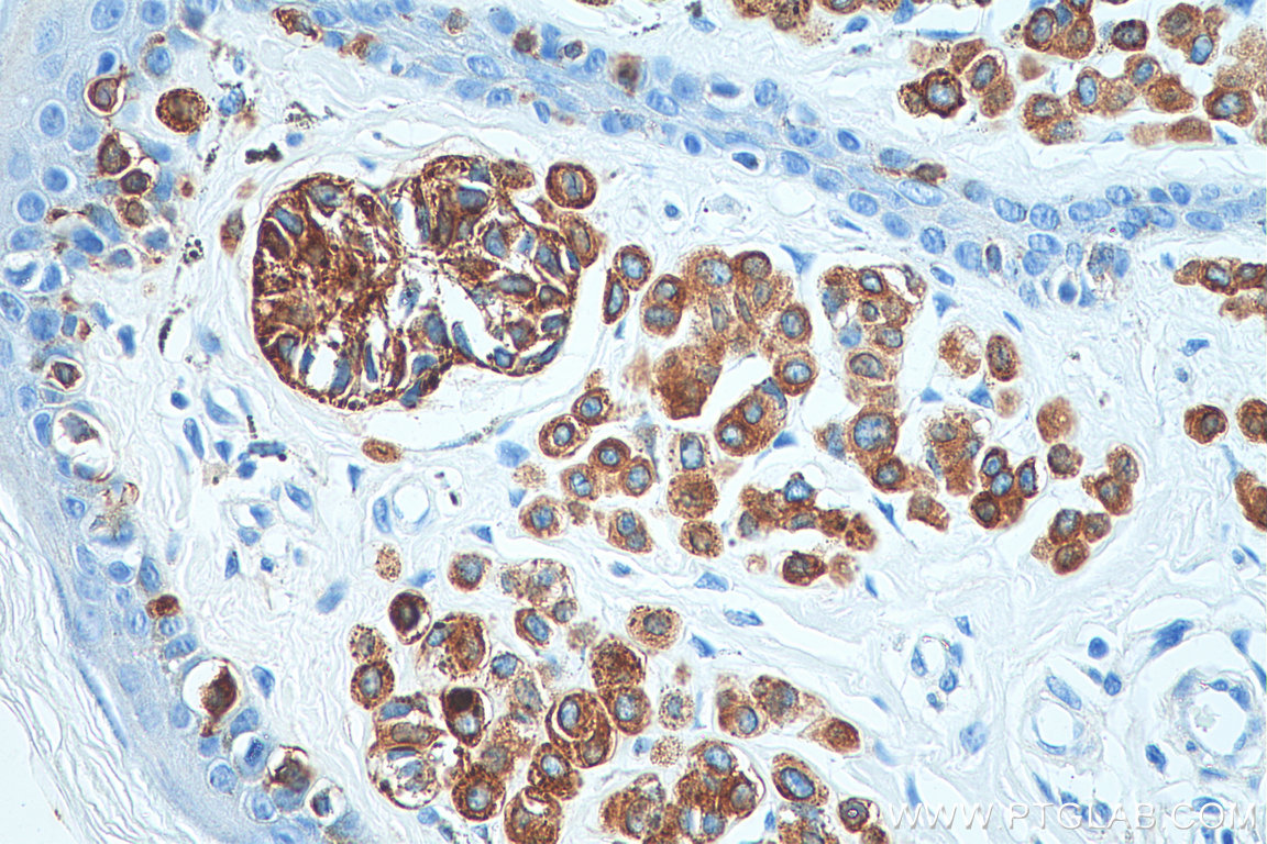 Immunohistochemistry (IHC) staining of human malignant melanoma tissue using Melan-A Polyclonal antibody (18472-1-AP)