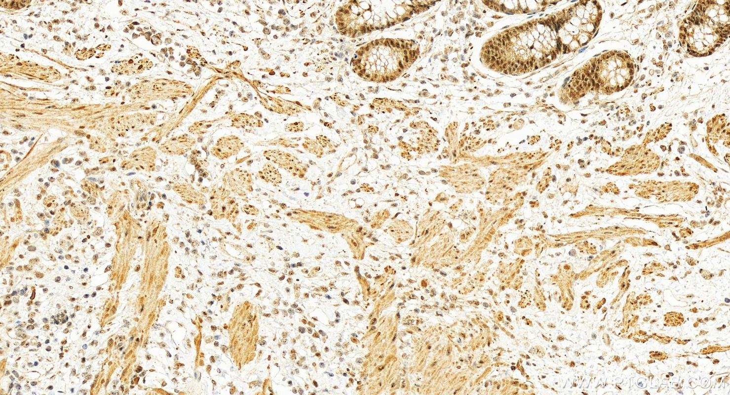 Immunohistochemistry (IHC) staining of human colon cancer tissue using MLF1 Polyclonal antibody (13100-1-AP)