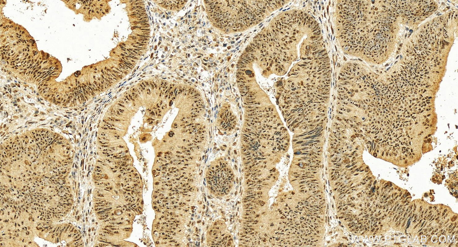 Immunohistochemistry (IHC) staining of human colon cancer tissue using MLF1 Polyclonal antibody (13100-1-AP)