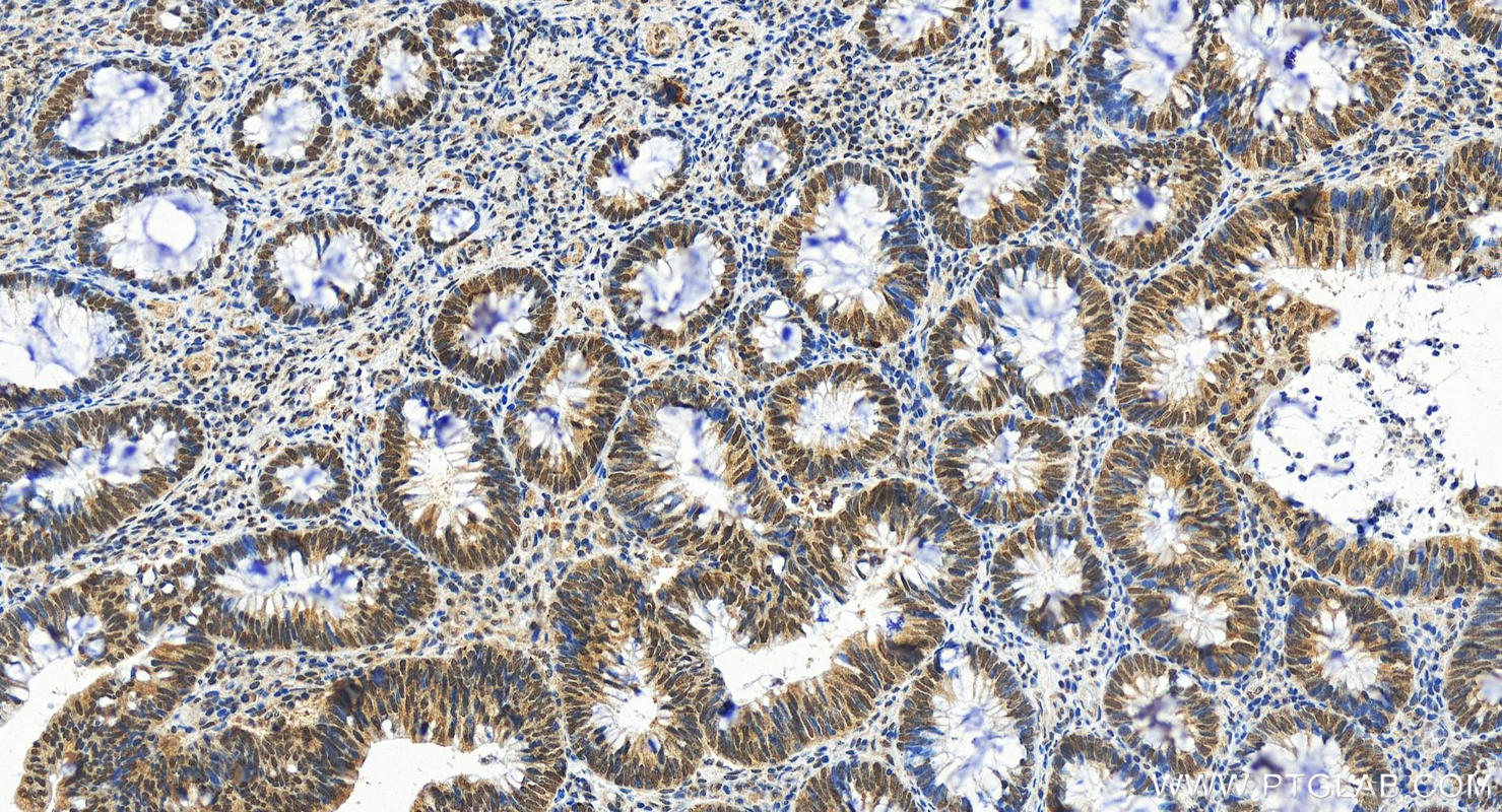 Immunohistochemistry (IHC) staining of human colon cancer tissue using MLH1 Recombinant antibody (84208-2-RR)