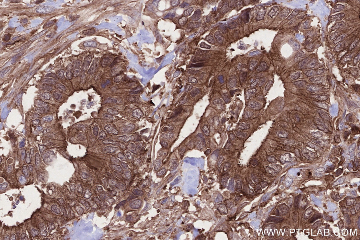 Immunohistochemistry (IHC) staining of human rectal cancer tissue using MLKL Monoclonal antibody (66675-1-Ig)