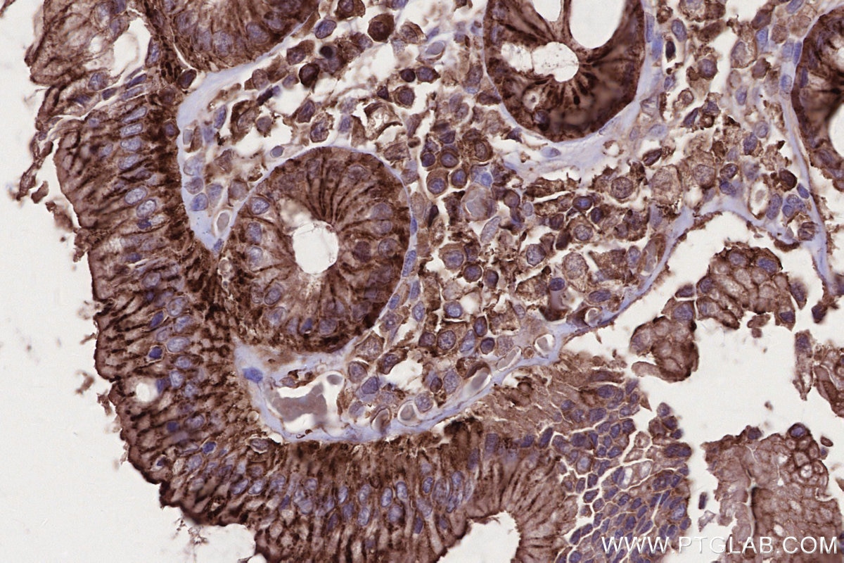 Immunohistochemistry (IHC) staining of human rectal cancer tissue using MLKL Monoclonal antibody (66675-1-Ig)