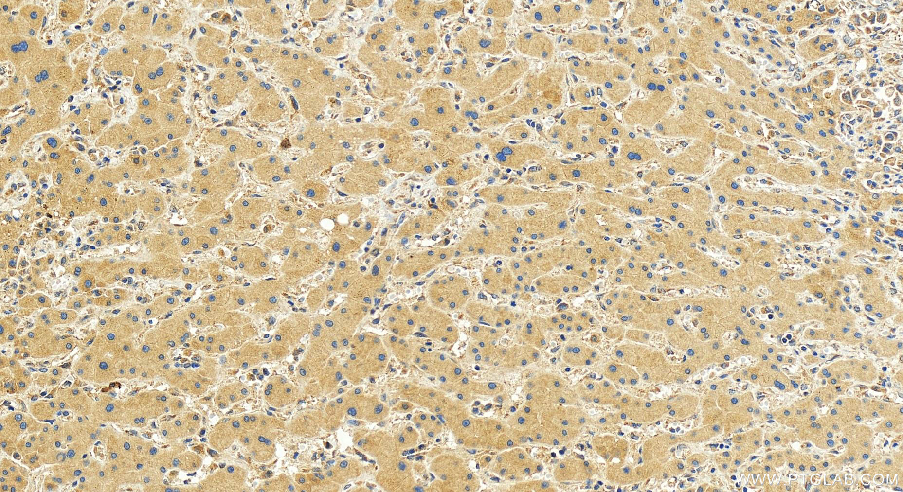 Immunohistochemistry (IHC) staining of human intrahepatic cholangiocarcinoma tissue using MLPH Polyclonal antibody (30618-1-AP)