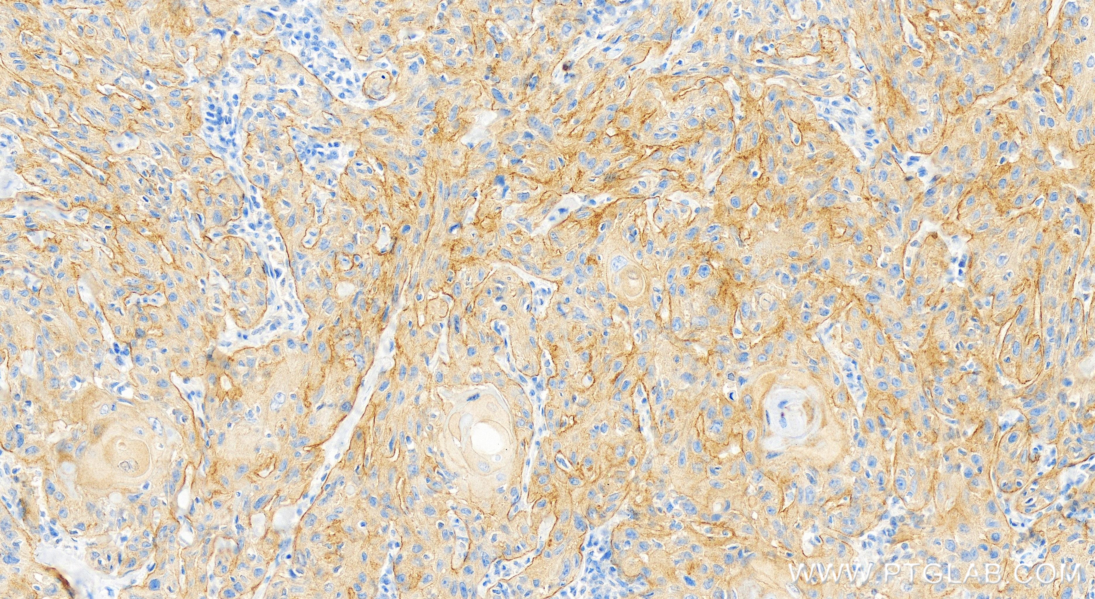 Immunohistochemistry (IHC) staining of human skin cancer tissue using MLPH Recombinant antibody (84282-1-RR)