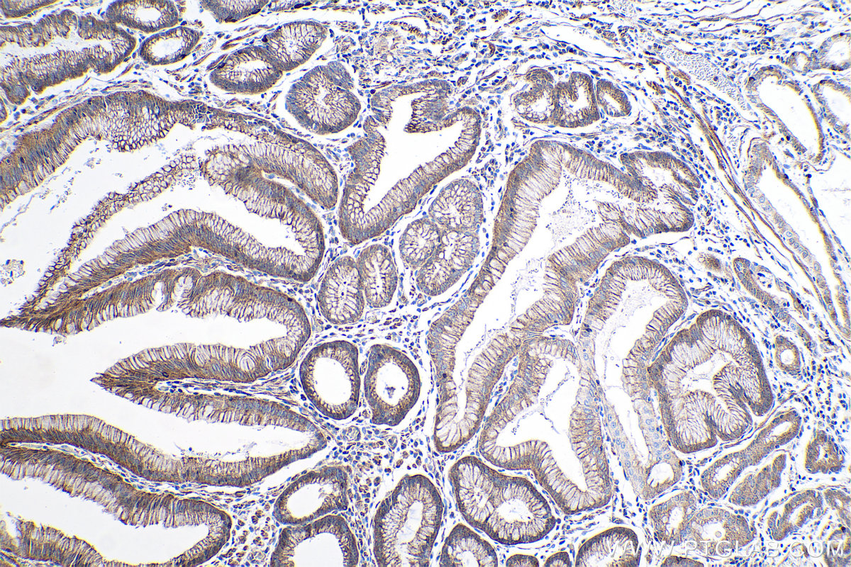 Immunohistochemistry (IHC) staining of human stomach cancer tissue using MME,CD10 Monoclonal antibody (60034-3-Ig)