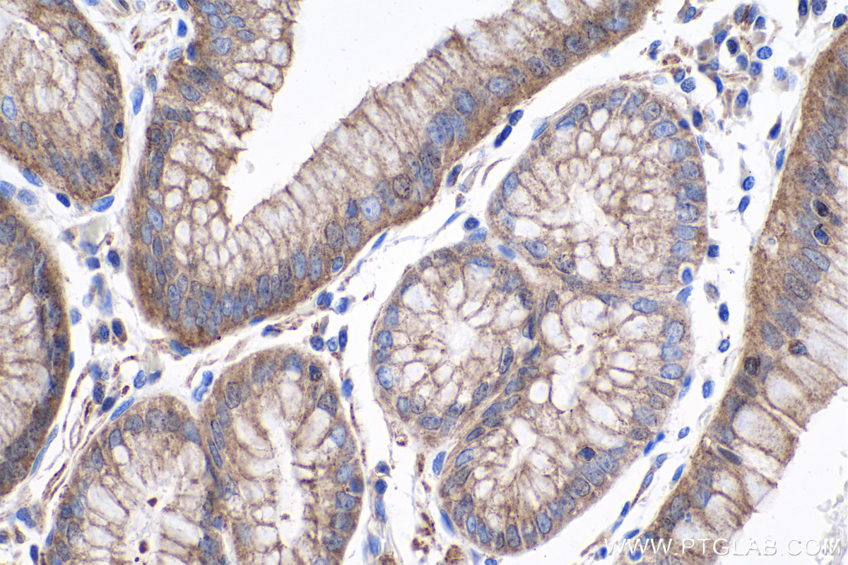 Immunohistochemistry (IHC) staining of human stomach cancer tissue using MME,CD10 Monoclonal antibody (60034-3-Ig)