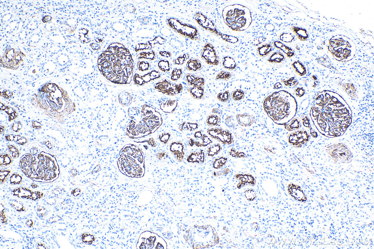 Immunohistochemistry (IHC) staining of human renal cell carcinoma tissue using MME,CD10 Monoclonal antibody (60034-3-Ig)