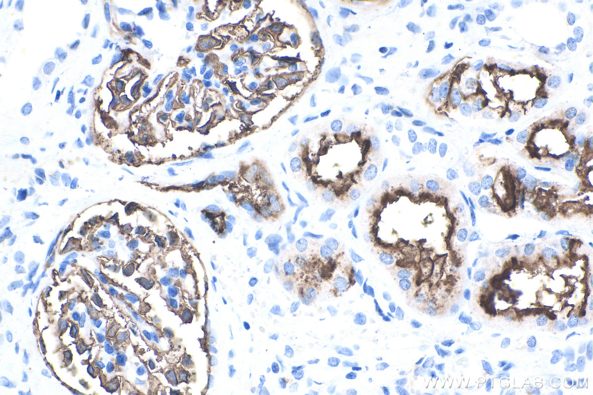 Immunohistochemistry (IHC) staining of human renal cell carcinoma tissue using MME,CD10 Monoclonal antibody (60034-3-Ig)