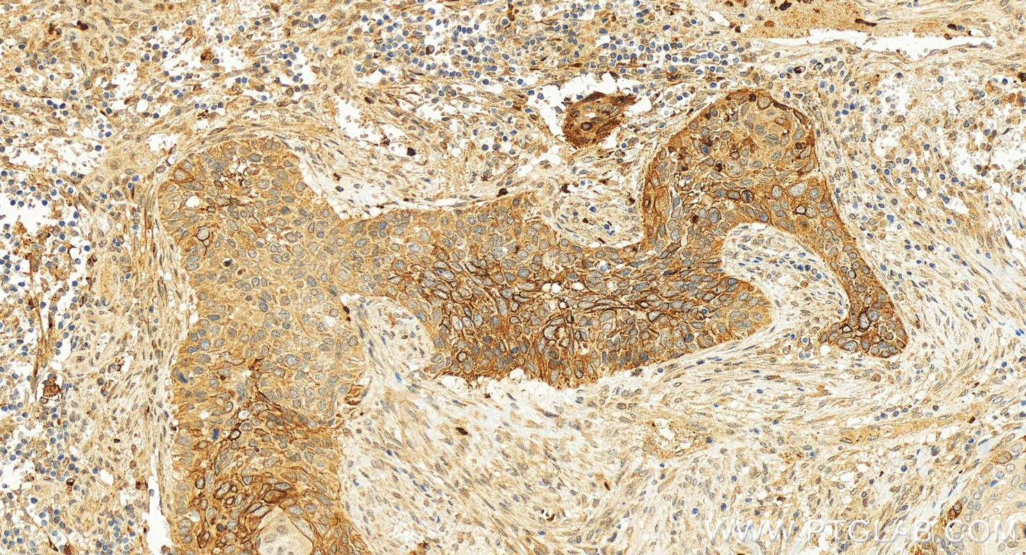 Immunohistochemistry (IHC) staining of human cervical cancer tissue using MMP1 Polyclonal antibody (30805-1-AP)