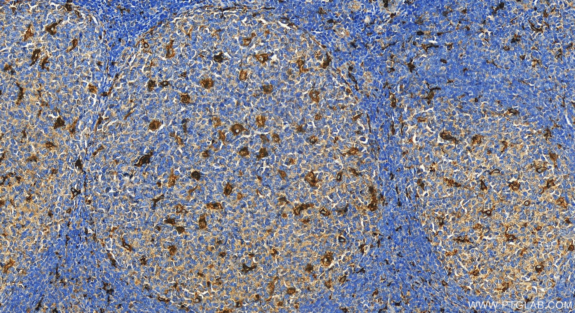 Immunohistochemistry (IHC) staining of human tonsillitis tissue using MMP-9 (Middle) Polyclonal antibody (27306-1-AP)