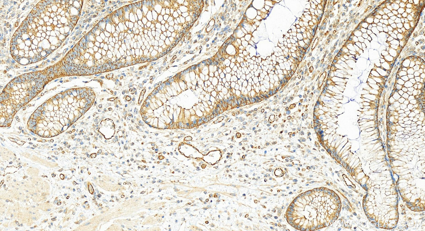 Immunohistochemistry (IHC) staining of human colon cancer tissue using MOBKL3 Polyclonal antibody (15886-1-AP)