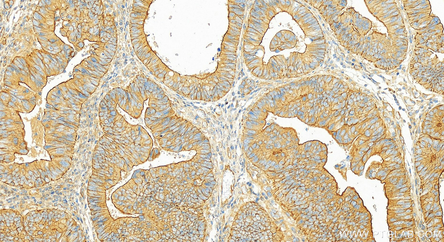 Immunohistochemistry (IHC) staining of human colon cancer tissue using MOBKL3 Polyclonal antibody (15886-1-AP)