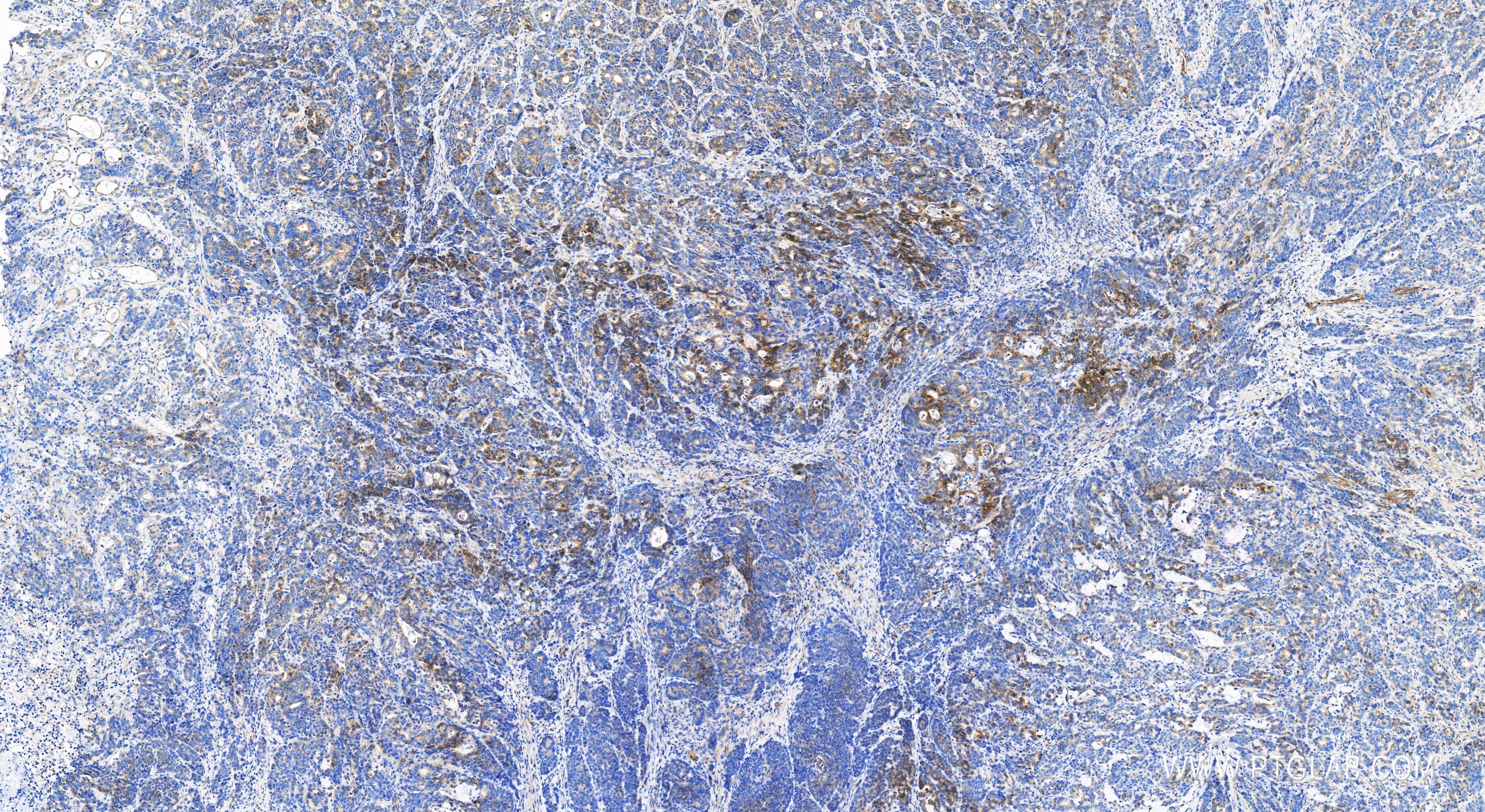 Immunohistochemistry (IHC) staining of human stomach cancer tissue using MOSC2 Recombinant antibody (83705-2-RR)