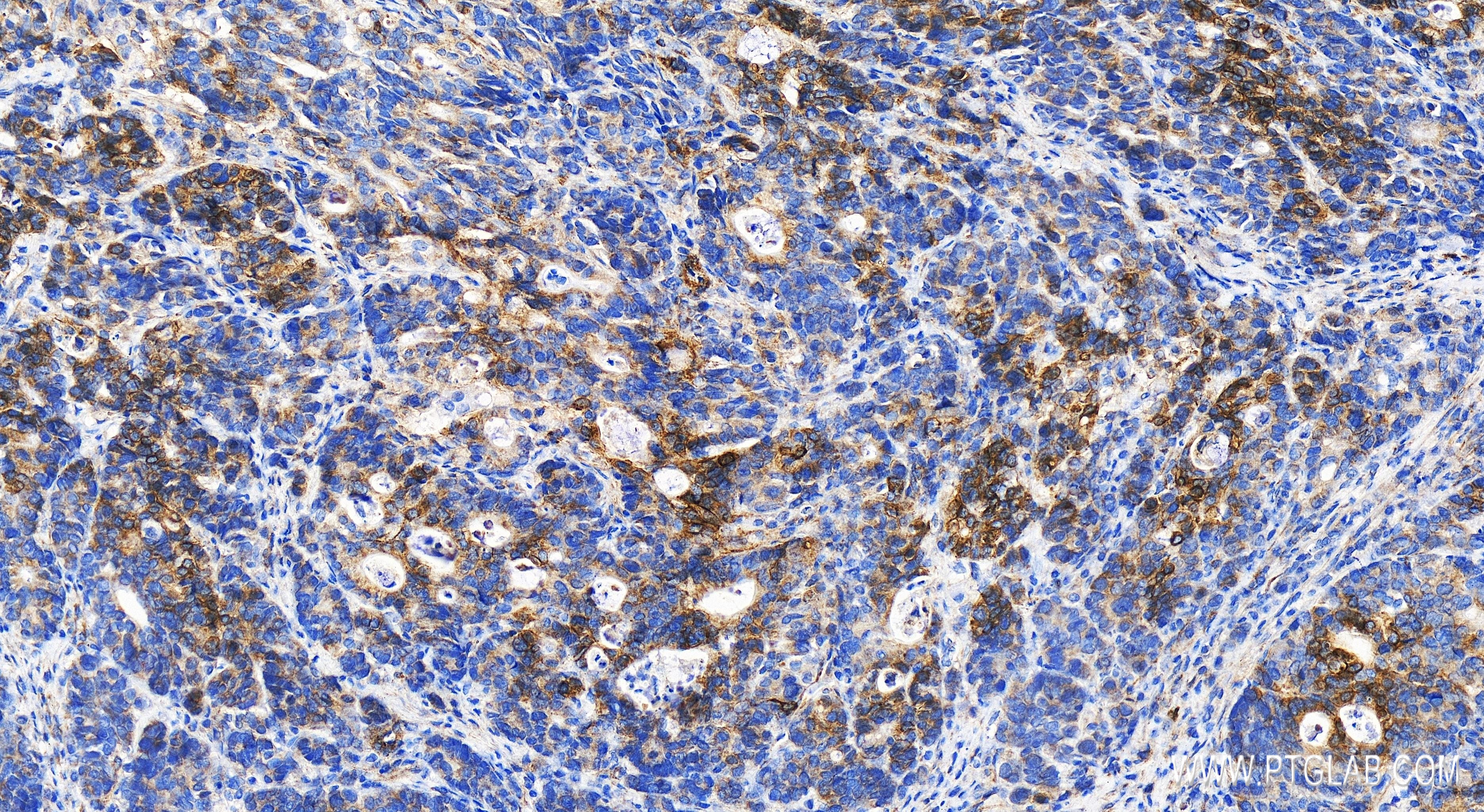 Immunohistochemistry (IHC) staining of human stomach cancer tissue using MOSC2 Recombinant antibody (83705-2-RR)