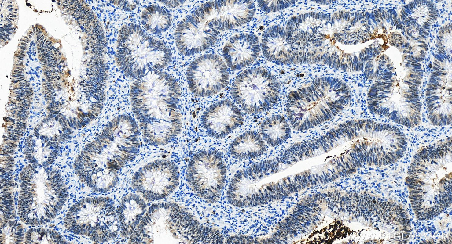 Immunohistochemistry (IHC) staining of human colon cancer tissue using MPO Recombinant antibody (81610-1-RR)