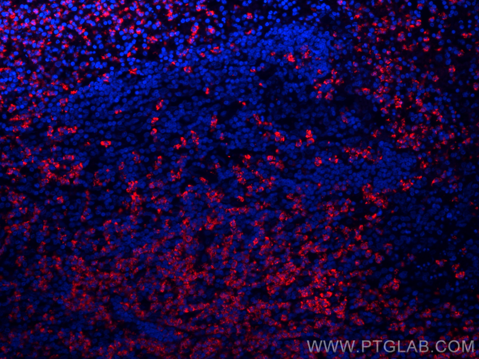 Immunofluorescence (IF) / fluorescent staining of human appendicitis tissue using CoraLite®594-conjugated MPO Monoclonal antibody (CL594-66177)