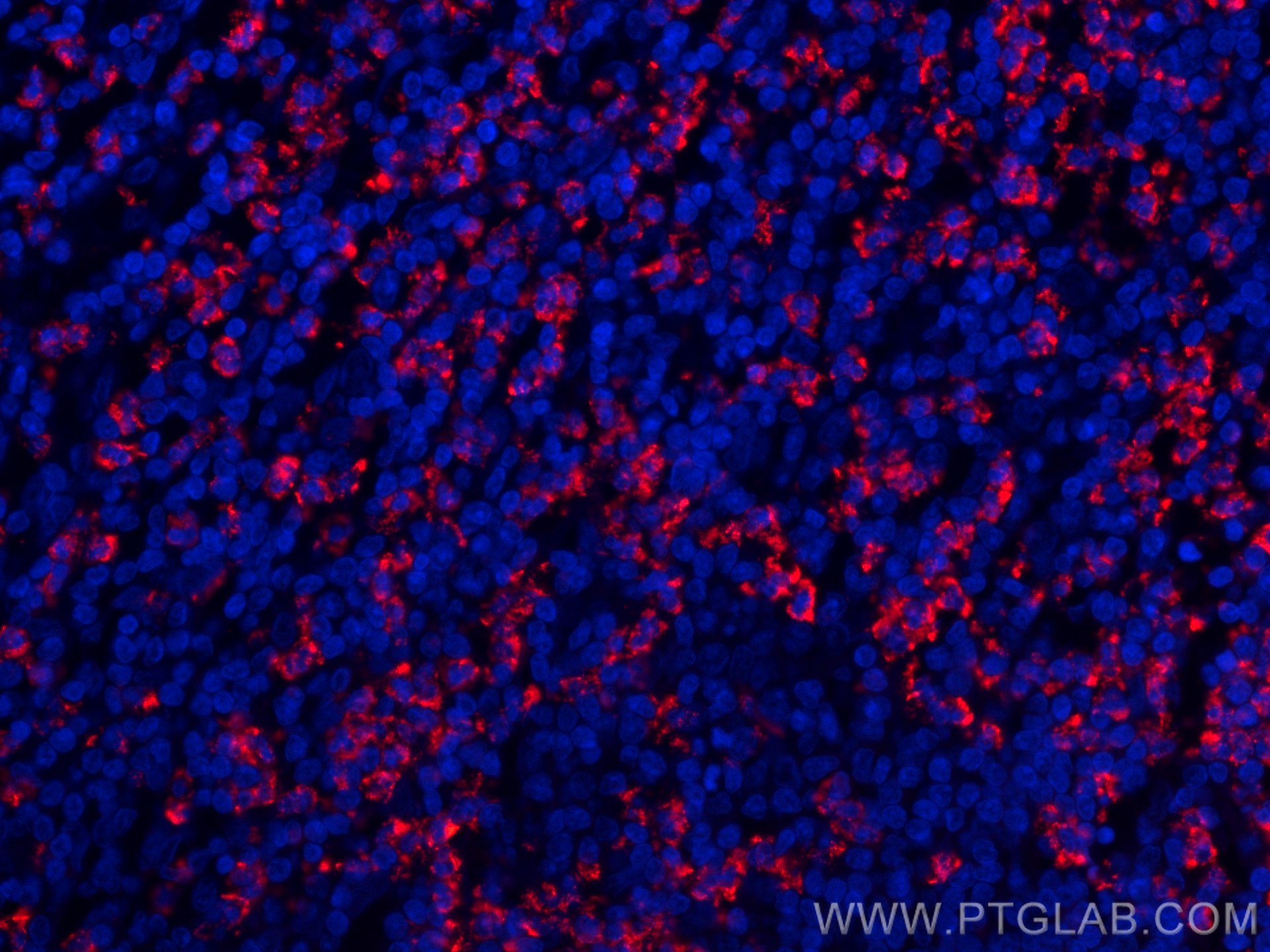 Immunofluorescence (IF) / fluorescent staining of human appendicitis tissue using CoraLite®594-conjugated MPO Monoclonal antibody (CL594-66177)