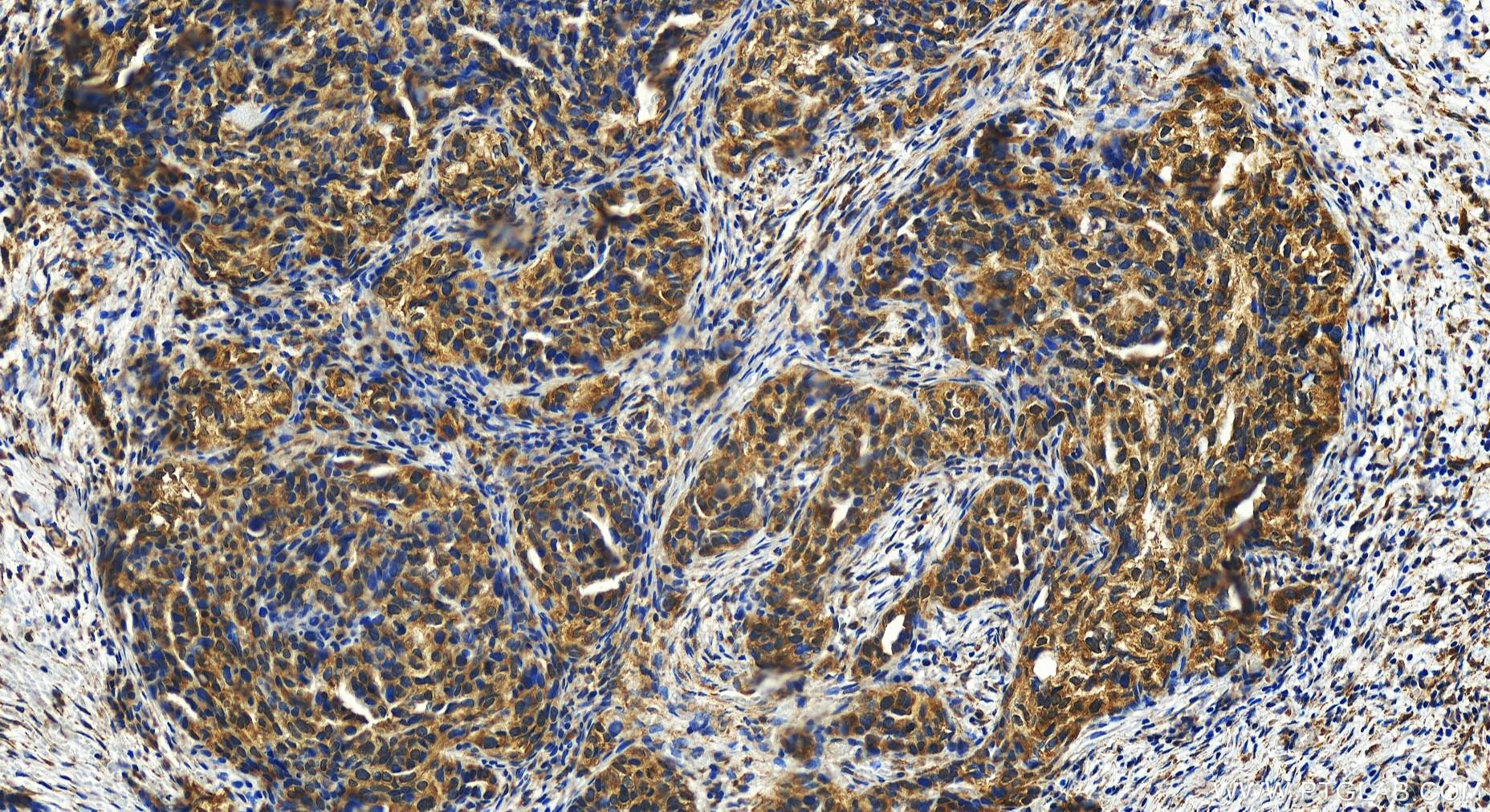 Immunohistochemistry (IHC) staining of human ovary cancer tissue using MPPE1 Polyclonal antibody (15313-1-AP)