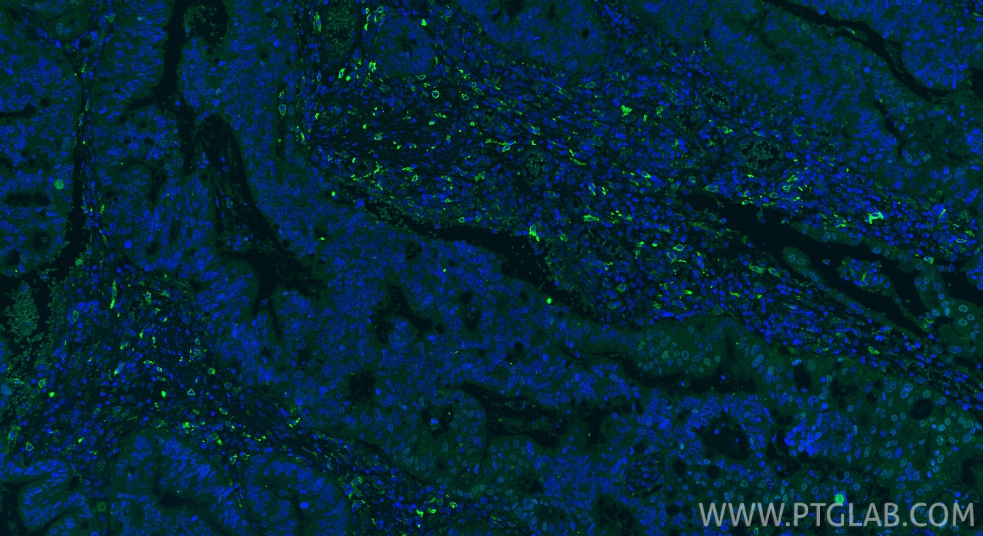 Immunofluorescence (IF) / fluorescent staining of human colon cancer tissue using CD206 Monoclonal antibody (60143-1-Ig)