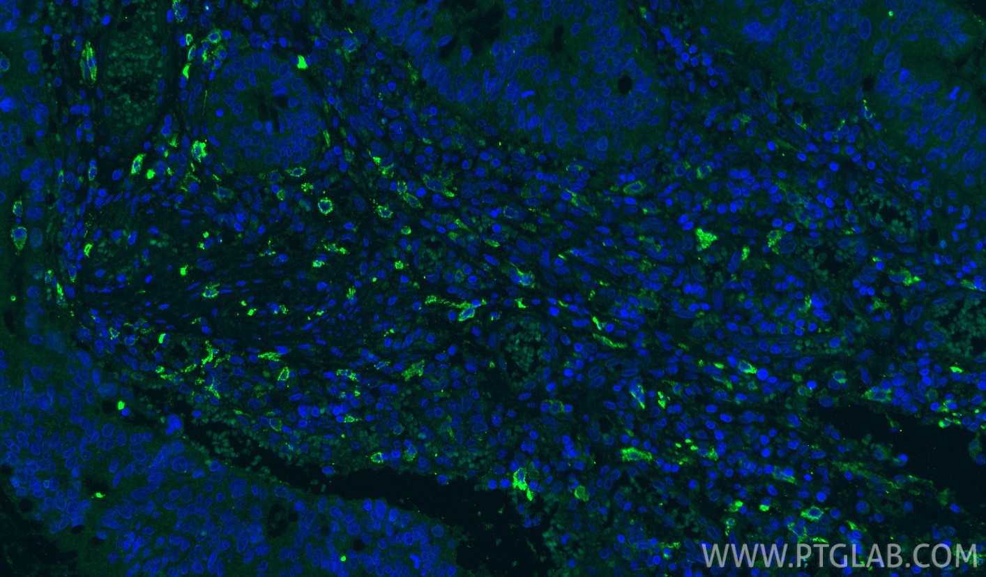 Immunofluorescence (IF) / fluorescent staining of human colon cancer tissue using CD206 Monoclonal antibody (60143-1-Ig)