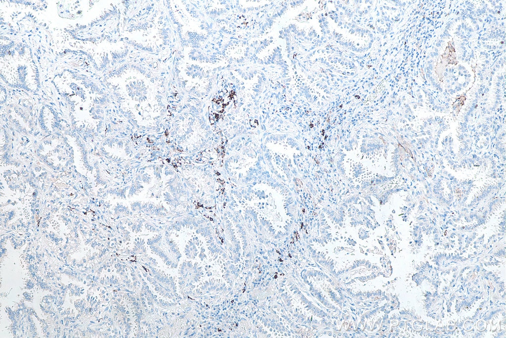 Immunohistochemistry (IHC) staining of human lung cancer tissue using CD206 Monoclonal antibody (60143-1-Ig)