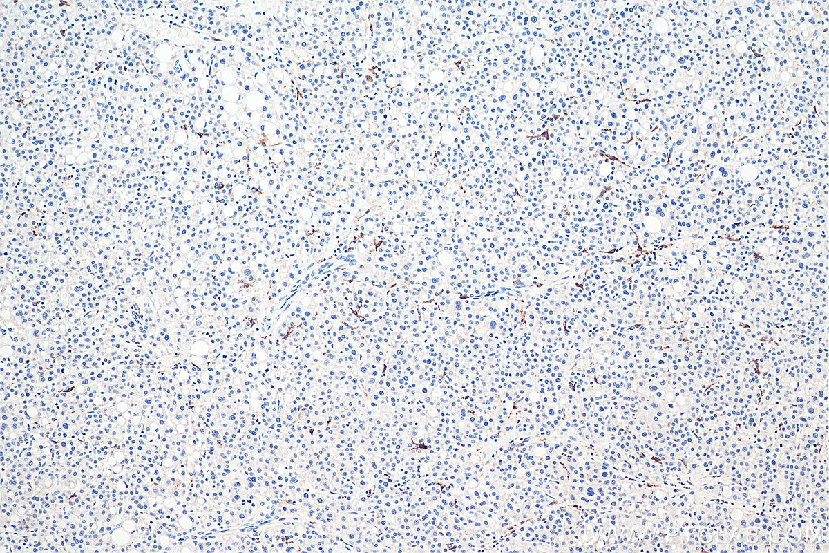 Immunohistochemistry (IHC) staining of human liver cancer tissue using CD206 Monoclonal antibody (60143-1-Ig)