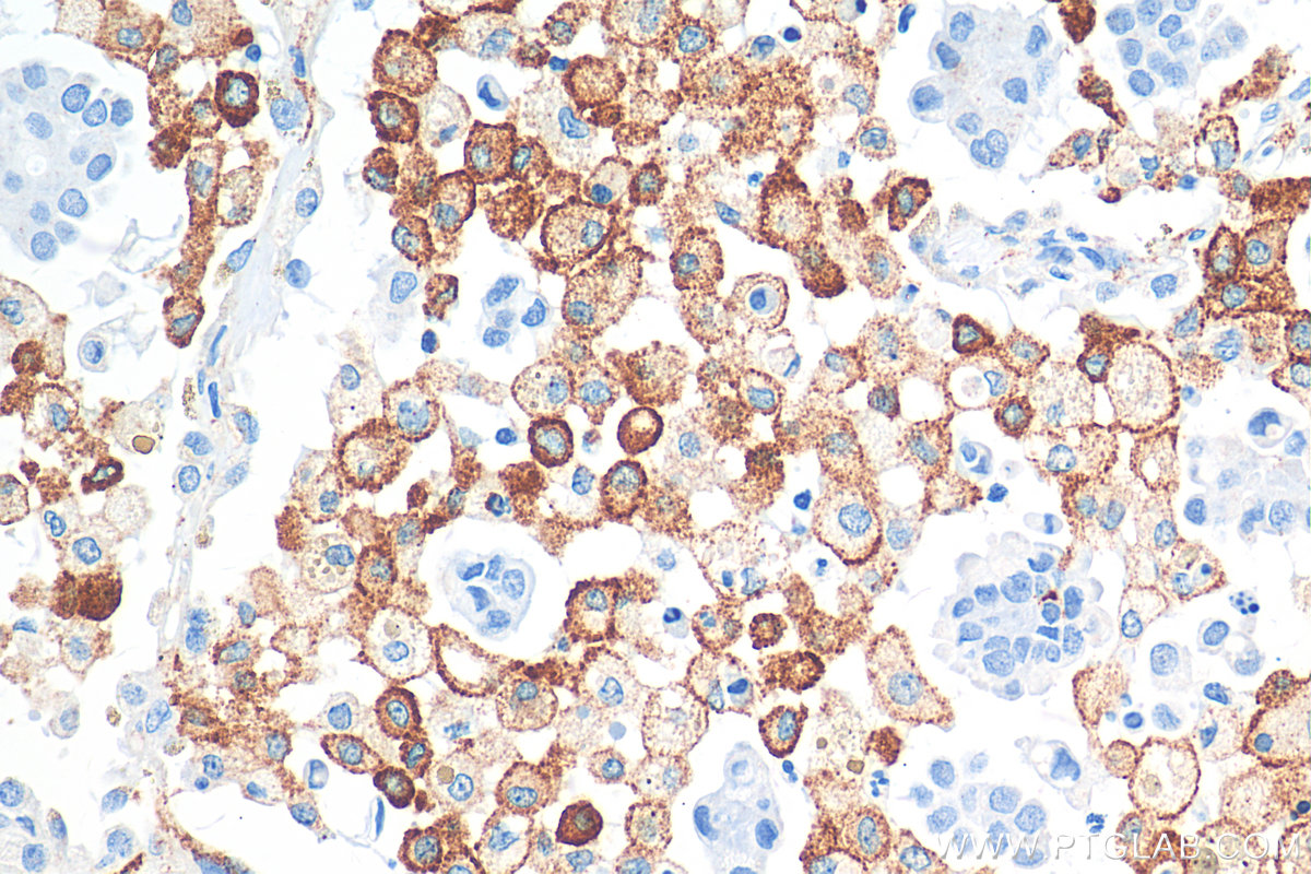 Immunohistochemistry (IHC) staining of human lung cancer tissue using CD206 Recombinant antibody (81525-1-RR)