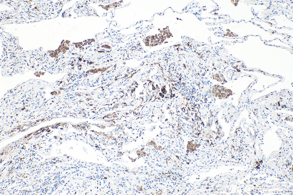 Immunohistochemistry (IHC) staining of human lung tissue using CD206 Recombinant monoclonal antibody (81525-1-RR)