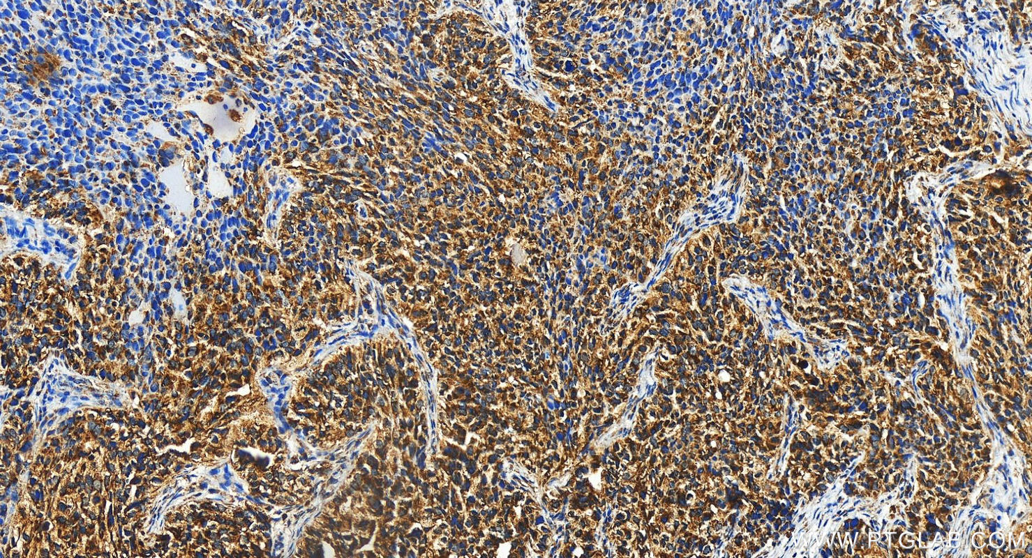 Immunohistochemistry (IHC) staining of human ovary cancer tissue using MRM1 Polyclonal antibody (16392-1-AP)