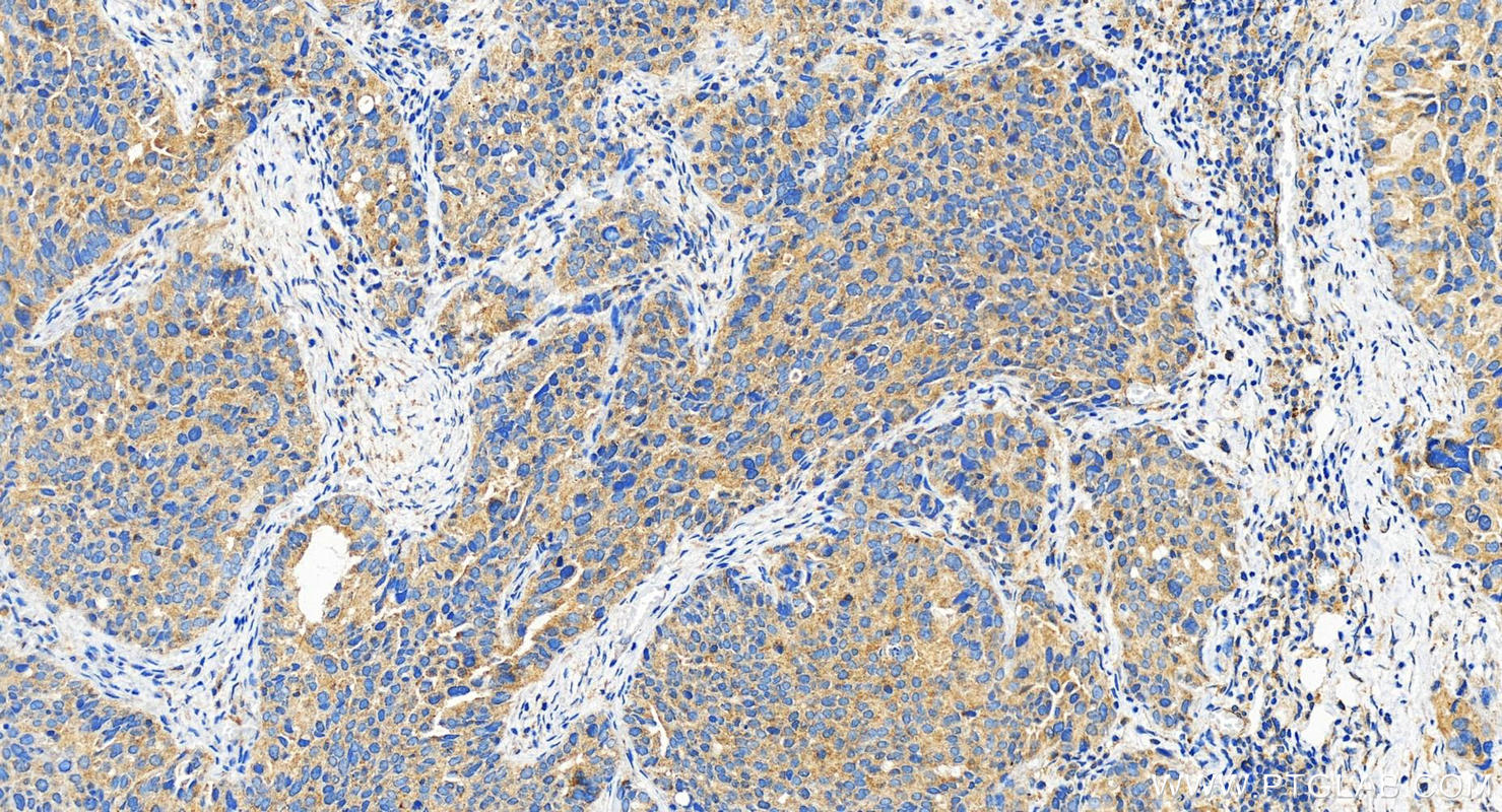 Immunohistochemistry (IHC) staining of human ovary cancer tissue using ABCC5 Polyclonal antibody (29792-1-AP)