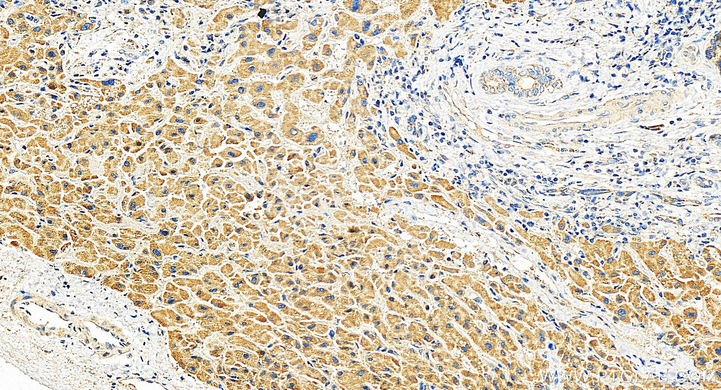 Immunohistochemistry (IHC) staining of human intrahepatic cholangiocarcinoma tissue using MRPL18 Polyclonal antibody (15178-1-AP)