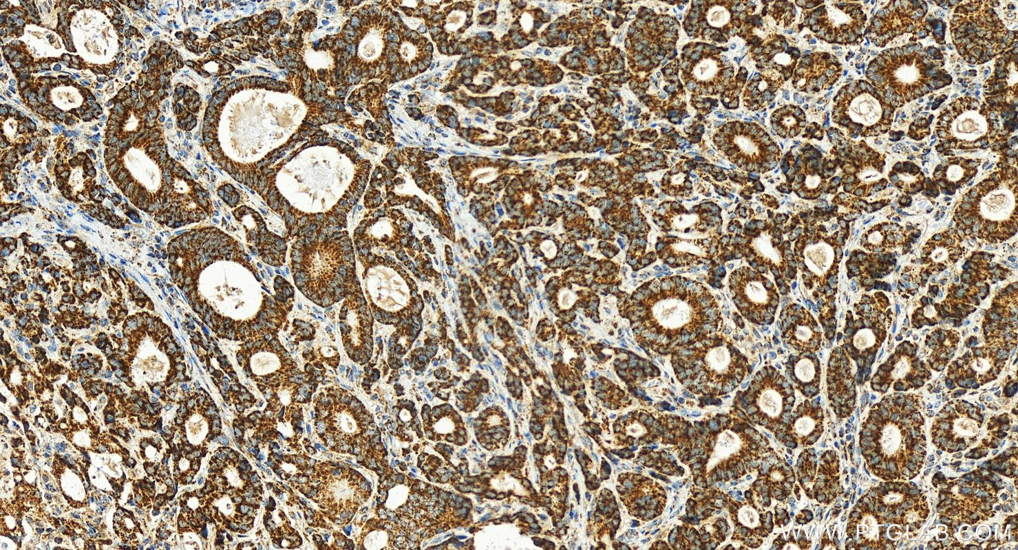 Immunohistochemistry (IHC) staining of human stomach cancer tissue using MRPL19 Polyclonal antibody (16517-1-AP)