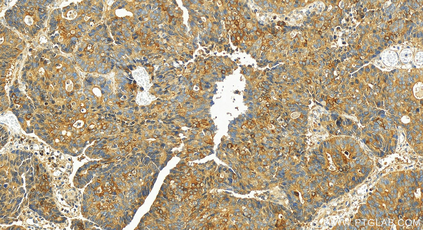 Immunohistochemistry (IHC) staining of human stomach cancer tissue using MRPL37 Polyclonal antibody (29522-1-AP)