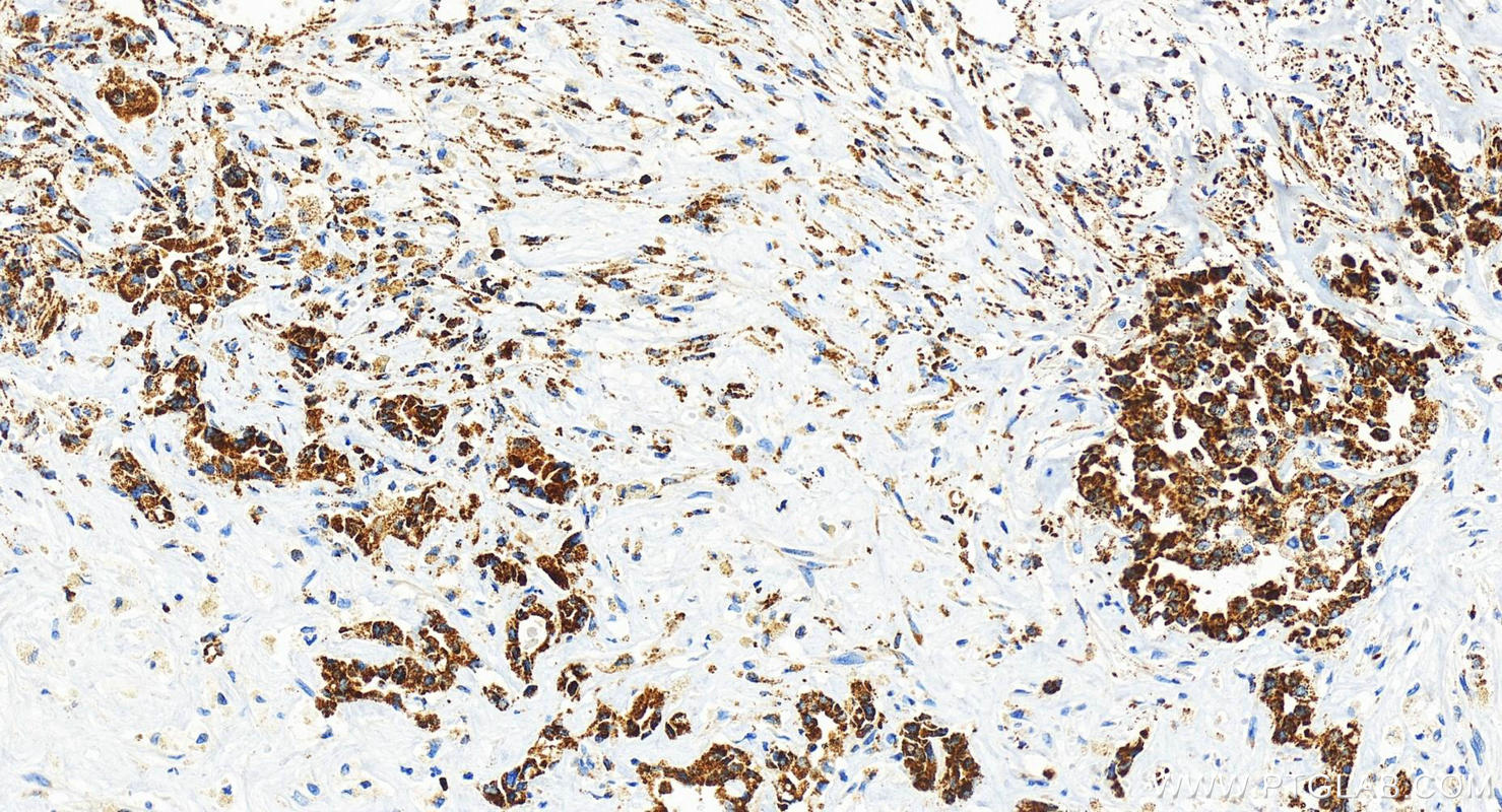 Immunohistochemistry (IHC) staining of human intrahepatic cholangiocarcinoma tissue using MRPL40 Recombinant antibody (83515-4-RR)