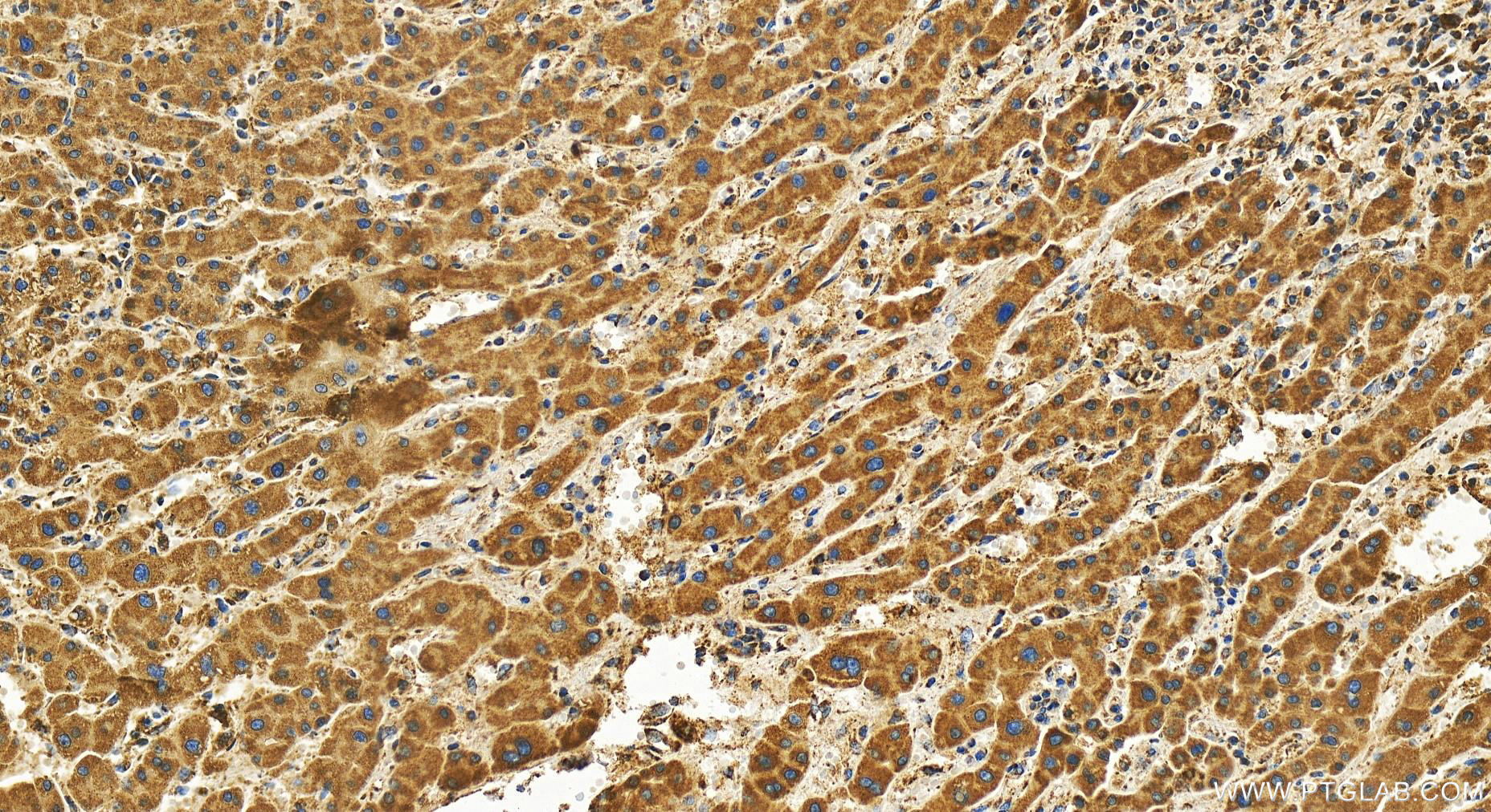 Immunohistochemistry (IHC) staining of human intrahepatic cholangiocarcinoma tissue using MRPS16 Recombinant antibody (82741-2-RR)