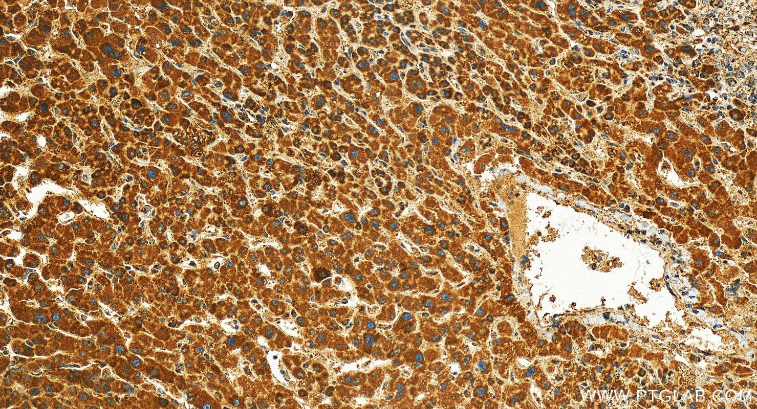 Immunohistochemistry (IHC) staining of human intrahepatic cholangiocarcinoma tissue using MRPS18A Polyclonal antibody (16235-1-AP)