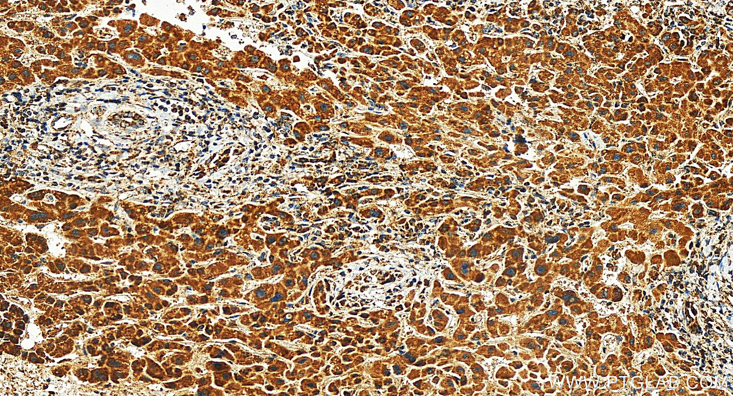 Immunohistochemistry (IHC) staining of human intrahepatic cholangiocarcinoma tissue using MRPS25 Polyclonal antibody (15277-1-AP)