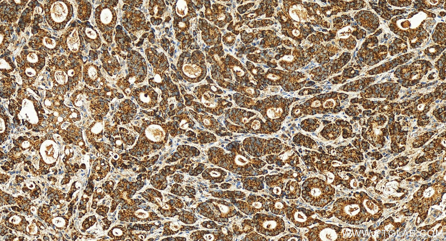 Immunohistochemistry (IHC) staining of human stomach cancer tissue using MRPS31 Polyclonal antibody (16288-1-AP)