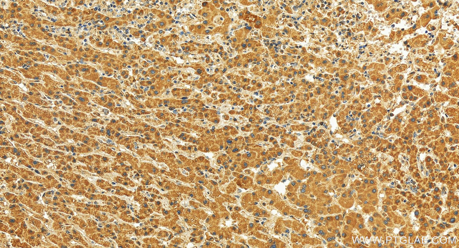 Immunohistochemistry (IHC) staining of human intrahepatic cholangiocarcinoma tissue using MRPS9 Polyclonal antibody (16533-1-AP)