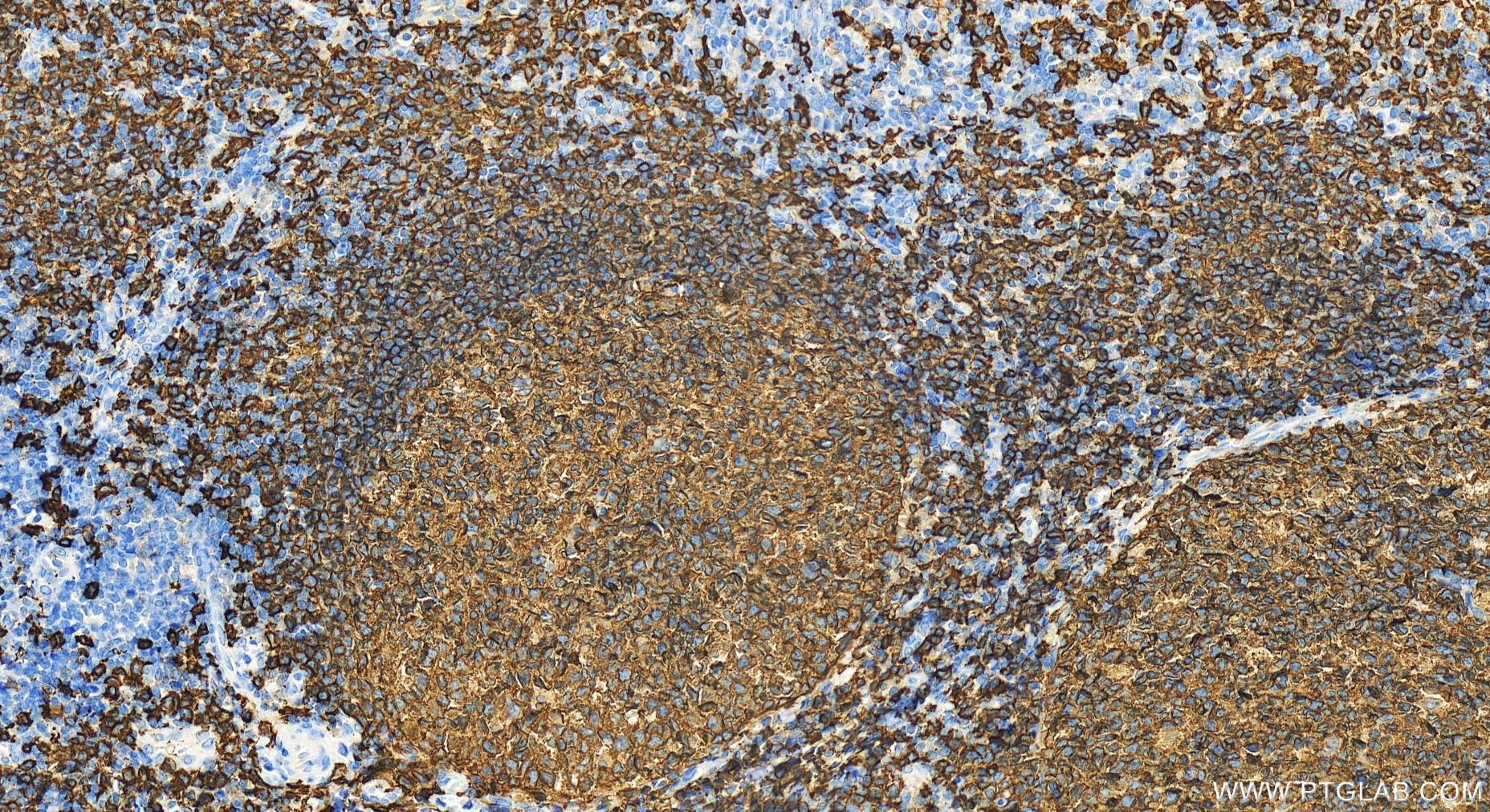 Immunohistochemistry (IHC) staining of human tonsillitis tissue using CD20 Polyclonal antibody (24828-1-AP)