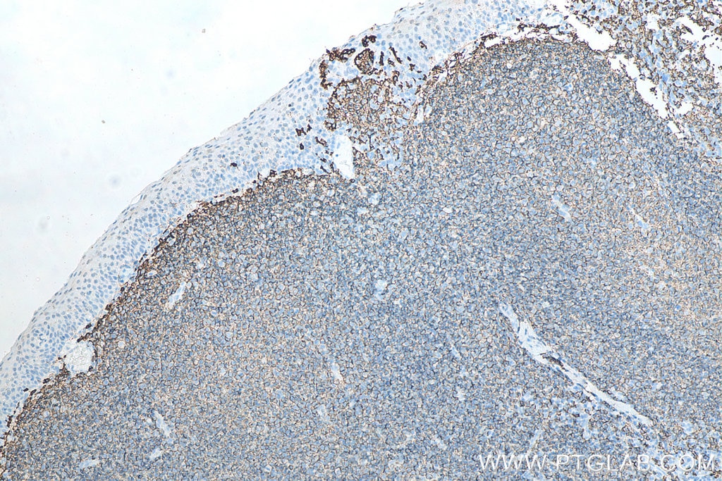 Immunohistochemistry (IHC) staining of human tonsillitis tissue using CD20 Monoclonal antibody (60271-1-Ig)