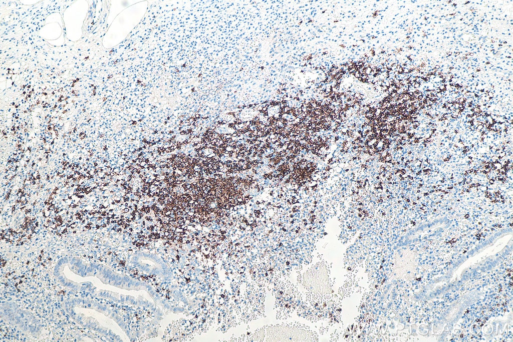 Immunohistochemistry (IHC) staining of human appendicitis tissue using CD20 Monoclonal antibody (60271-1-Ig)