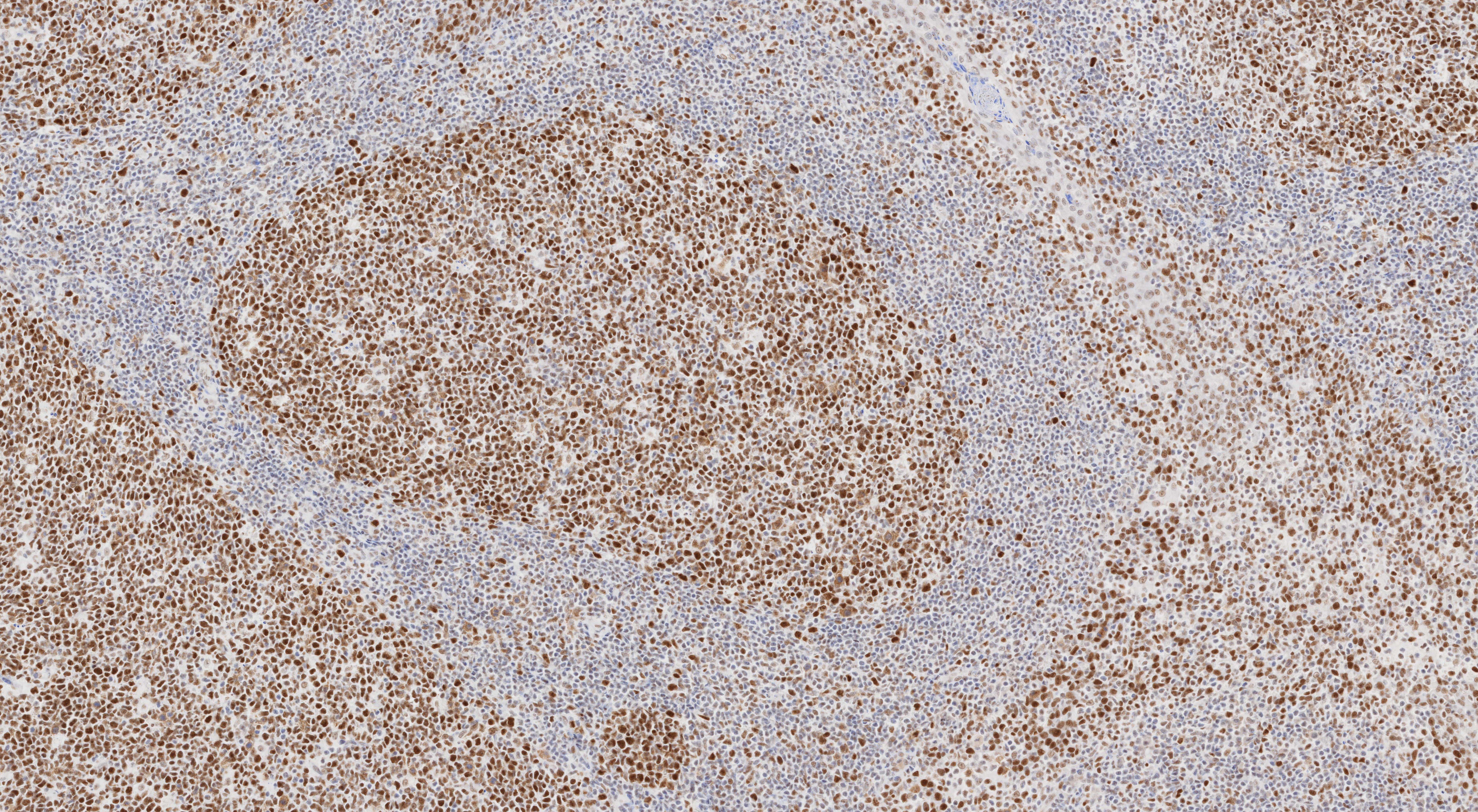 Immunohistochemistry (IHC) staining of human tonsillitis tissue using MSH2 Monoclonal antibody (60161-2-Ig)